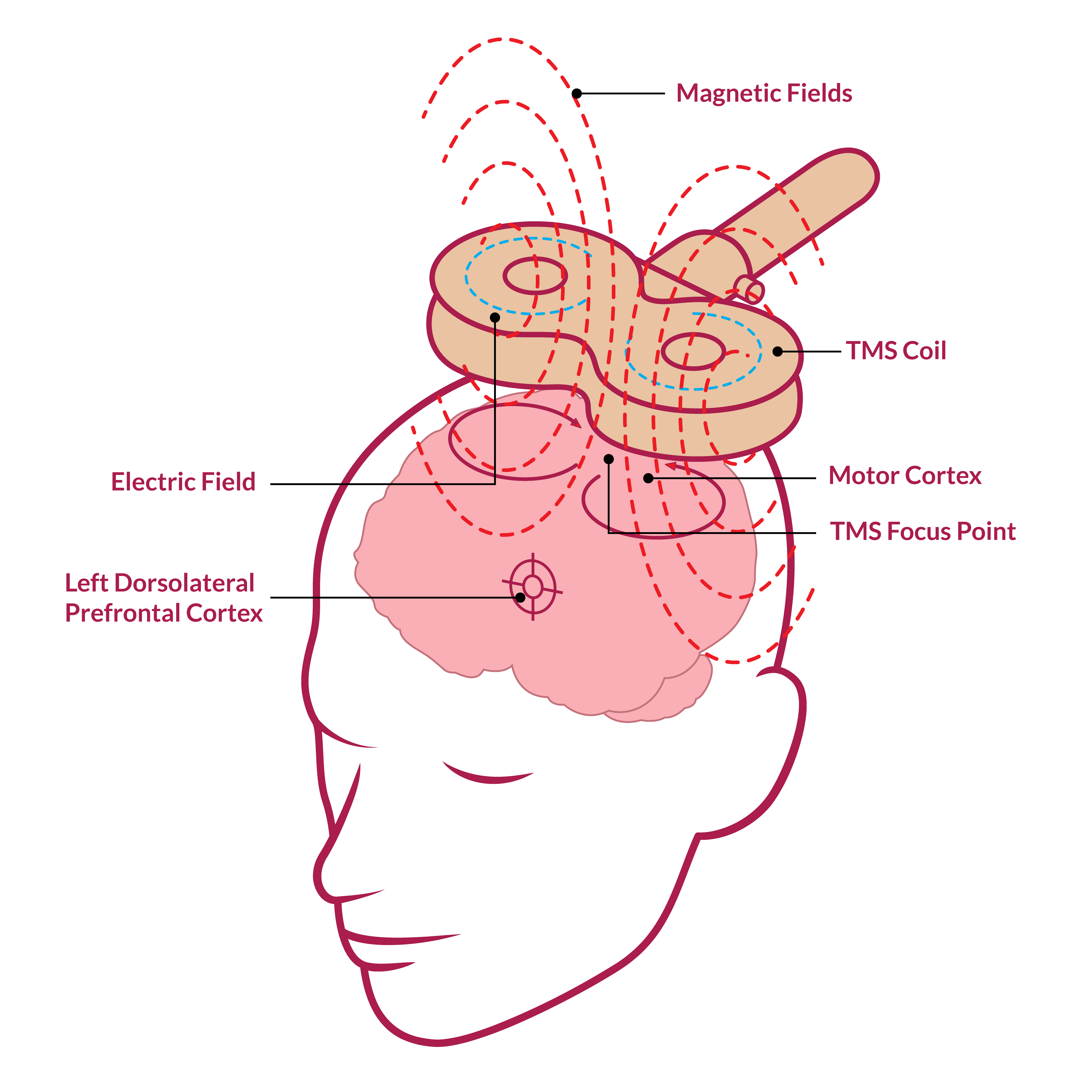 Placeholder showing a Deep TMS treatment chair and device
